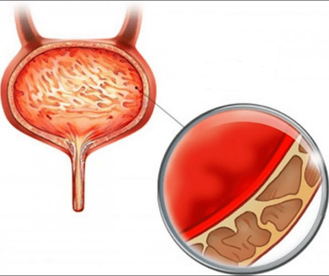 Ontsteking van cystitis
