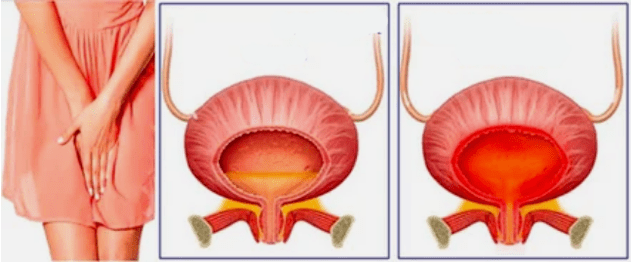 Chronische cystitis