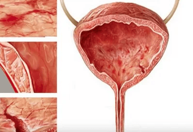 De redenen voor de ontwikkeling van cystitis bij vrouwen